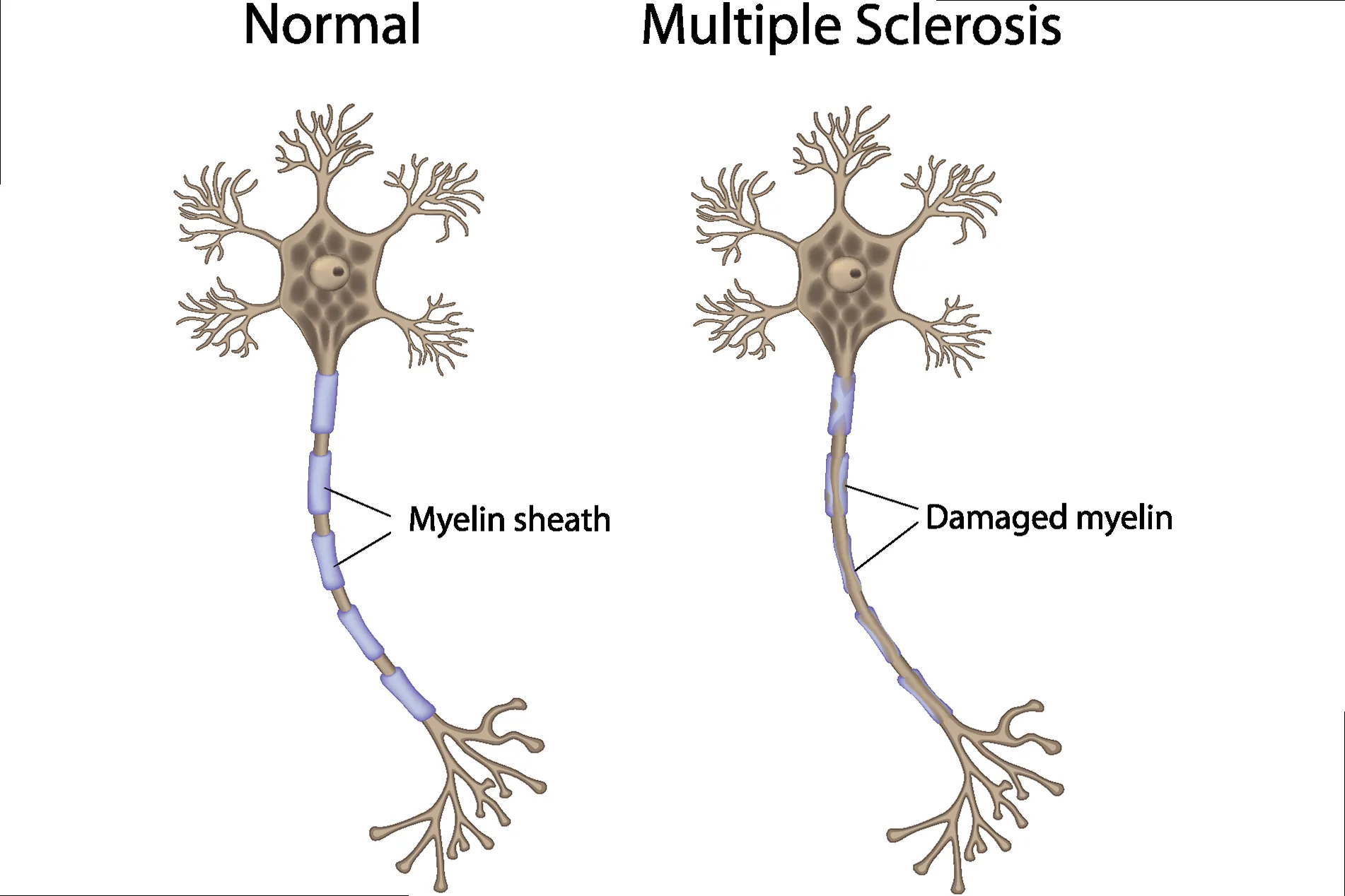 A hand gently holding a brain illustration, symbolizing the impact of MS on the central nervous system.